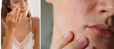 7 cremas para rosácea de 2025 que hidratan, protegen y mantienen tu piel sana 7 cremas para rosácea de 2025 que hidratan, protegen y mantienen tu piel sana