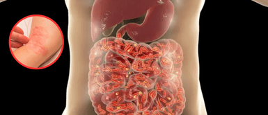 Hongo cándida. ¿Qué es una dieta para la limpieza de cándida y qué es lo que hace?