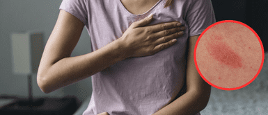 Cáncer de mamá. Manchas rojas en los senos: ¿una señal de alerta? Esto dicen los expertos