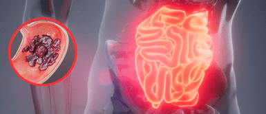 Cáncer de estomago. Aumentan los casos de cáncer de estómago en jóvenes: Por qué ocurre y qué señales no deben ser ignoradas