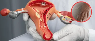 VPH en mujeres. Aumentan los casos de cáncer cervicouterino por VPH en mujeres jóvenes