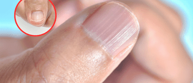 Rayas en las uñas. ¿Tienes rayas o surcos en las uñas? Podría ser la señal de algo mucho más grave de lo que imaginas