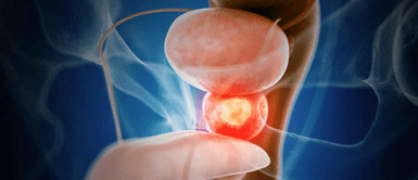 Cáncer de próstata. Los hábitos silenciosos que podrían estar dañando tu próstata y no lo sabías