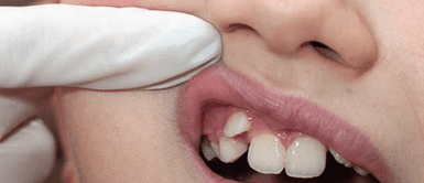 Dientes. Estos 5 hábitos que haces sin darte cuenta podrían estar torciendo tus dientes