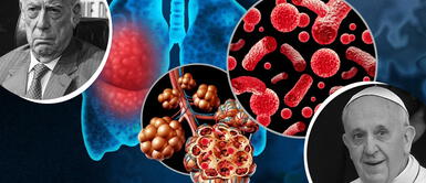 Los peligros de la neumonía: la silenciosa enfermedad que se llevó al Papa Francisco, Mario Vargas Llosa y otros grandes del mundo Los peligros de la neumonía: la silenciosa enfermedad que se llevó al Papa Francisco, Mario Vargas Llosa y otros grandes del mundo