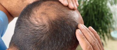 Caída de cabello Urgente: Advierten que famoso medicamento contra la caída del cabello puede causar disfunción eréctil