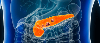 Descubren fármaco que podría cambiar para siempre la lucha contra el cáncer de páncreas. ¡Esperanza real! Descubren fármaco que podría cambiar para siempre la lucha contra el cáncer de páncreas
