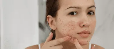 Estas son las causas ocultas y cuándo debes correr al dermatólogo. ¿Acné sin control? Estas son las causas ocultas y cuándo debes correr al dermatólogo
