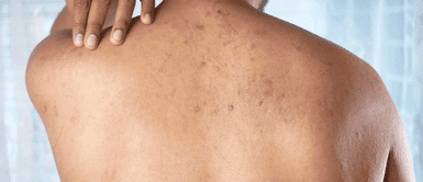 Manchas en la espalda ¿Tienes manchas en la espalda? Conoce en qué momento puede ser señal de una enfermedad