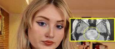 Joven ignoró por años estos síntomas y resultó tener cáncer. Ignoró estos síntomas por años: Joven descubrió que tenía cáncer cerebral