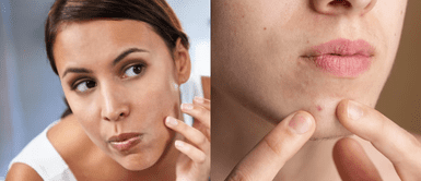 Productos para secar espinillas rápido Los 7 productos más efectivos para secar espinillas rápido (sin dañar la piel)