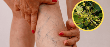 La hierba reduce varices y arañas vasculares, según la UNAM Esta hierba reduce varices y arañas vasculares según la UNAM, y está al alcance de todos