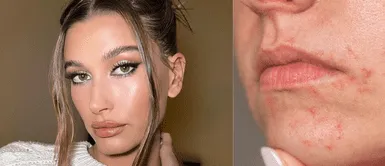 Hailey Bieber Hailey Bieber confiesa que tiene dermatitis perioral y revela sus mejores secretos beauty