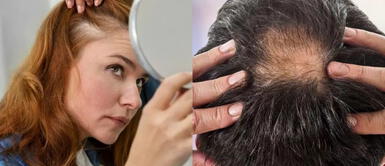 remedio casero que detiene la calvicie ¡Detén la caída del cabello! Este remedio casero combate la alopecia y devuelve vida a tu melena