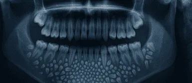 Más de 500 dientes en un niño Récord médico: doctores extraen 526 piezas dentales a un niño en una sola intervención