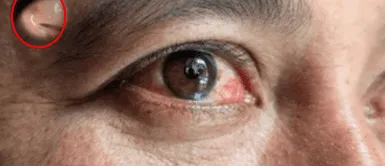 El parásito normalmente infecta a perros y gatos Hombre descubre que tenía un gusano vivo en su ojo tras presentar visión borrosa y enrojecimiento