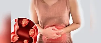 Advierten el factor de riesgo de cáncer de colon Advierten el factor de riesgo de cáncer de colon en jóvenes que nadie quiere ver, y suele subestimarse