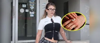 Flavia Laos sorprendió al compartir el mal que está sufriendo. ¿Qué es la psoriasis guttata y cómo se trata? Enfermedad que sufre Flavia Laos