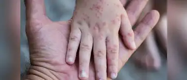 ¡Alerta epidemiológica! Reportan más de 30 CASOS de CONTAGIOSO VIRUS que ataca a niños en el PERÚ ¡Alerta epidemiológica! Reportan más de 30 casos de contagioso virus que ataca a niños en el PERÚ