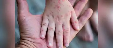 ¡Alerta epidemiológica! Reportan más de 300 casos de contagioso virus que ataca a niños en el PERÚ ¡Alerta epidemiológica! Reportan más de 300 casos de contagioso virus que ataca a niños en el PERÚ