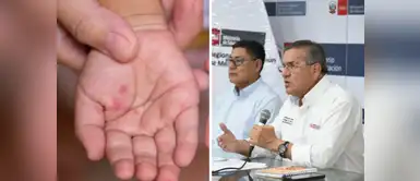 Alerta por incremento de casos del virus Coxsackie Alerta por incremento de casos del virus Coxsackie: ¿Quiénes corren más peligro y cómo se contagia?