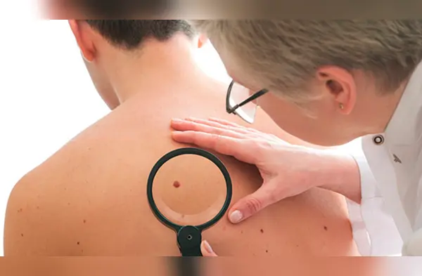 Previene el cáncer de piel, asistiendo a estas campañas de despitaje wapa.pe