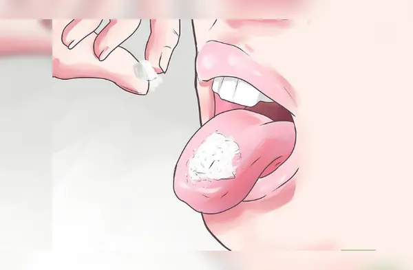 Remedios caseros para aliviar las quemaduras de lengua wapa.pe