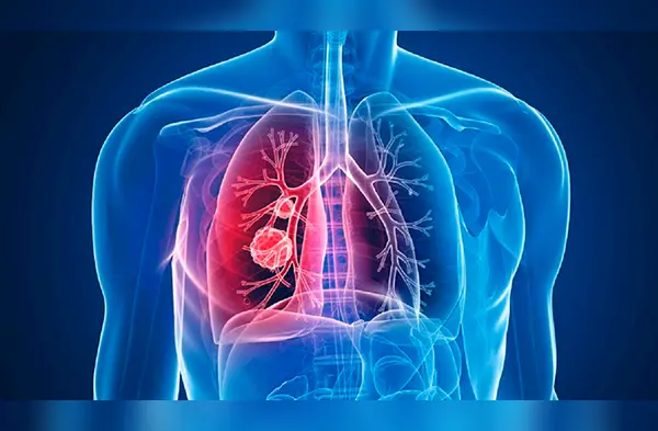 Cáncer de pulmón: cómo funciona la inmunoterapia (Foto: Nota de Prensa) wapa.pe