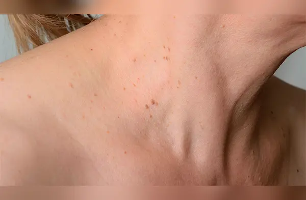 Con estos ingredientes podrás preparar el remedio casero para eliminar las verrugas wapa.pe