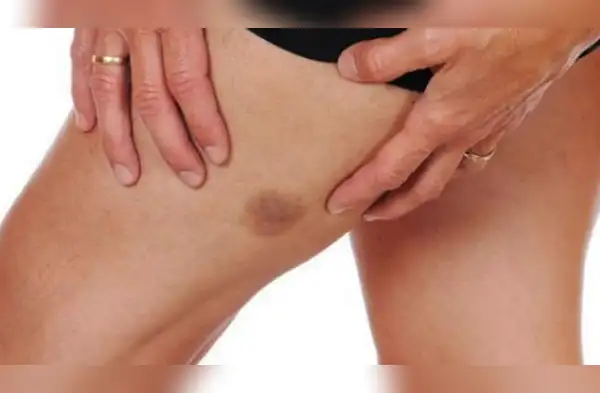 Elimina los moretones con estos remedios caseros. wapa.pe