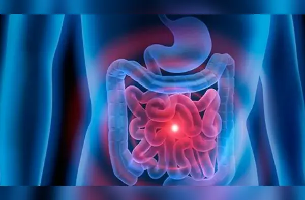 Malabsorción intestinal multidisciplinar: todo lo que debes de saber de esta enfermedad wapa.pe