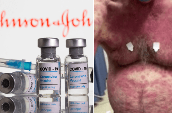 Coronavirus: Hombre sufrió extraño efecto secundario en la piel tras recibir la vacuna anticovid-19 de Johnson & Johnson