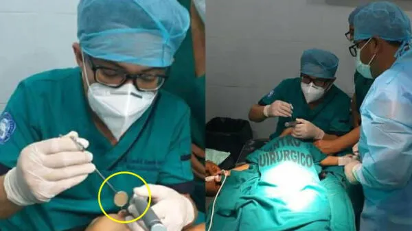 Cirujanos en Loreto extraen moneda de sol que se tragó una niña de 1 año y tres meses de edad