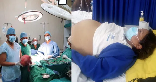 Cirujanos extirpan tumor gigante a mujer que tenía la apariencia de estar embarazada