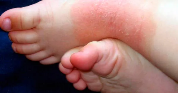 Día Mundial de la Dermatitis Atópica: Especialista explica qué es y cuáles son sus síntomas en menores de edad