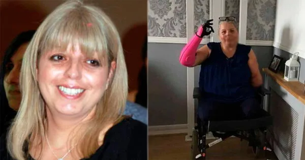 Reino Unido: Mujer de 52 años sufrió una sepsis y le amputaron sus extremidades