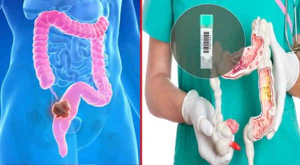 El tamizaje del cáncer de colon y recto se recomienda para personas entre 50 y 75 años