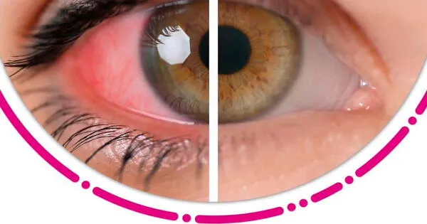 La uveítis es la inflamación de la capa media al interior del ojo, puede generar pérdida de visión