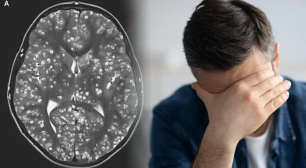Encuentran larvas en el cerebro a hombre que sufría de migrañas: no se lavaba bien las manos