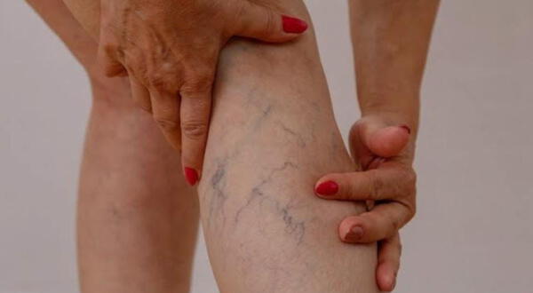 El doctor indica que la principal causa de esta afección es genética. wapa.pe