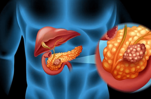 Cáncer de páncreas. wapa.pe