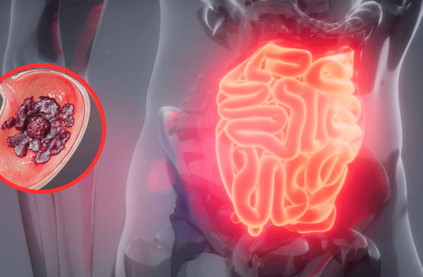 Cáncer de estomago. wapa.pe