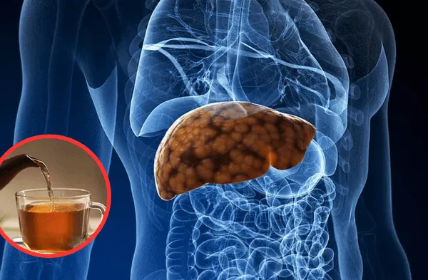 ¡Adiós al hígado graso! La infusión natural que lo limpia con solo un vaso al día wapa.pe