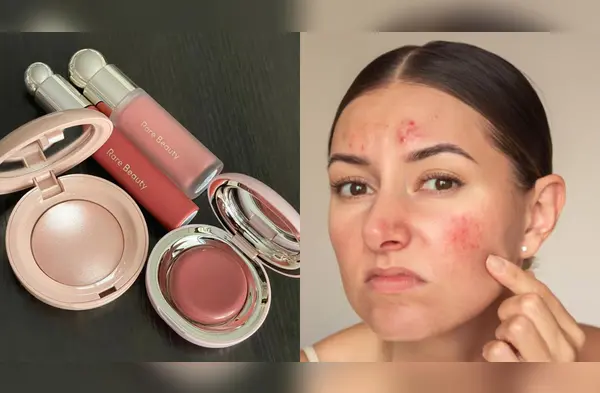 Rubor y rosácea wapa.pe