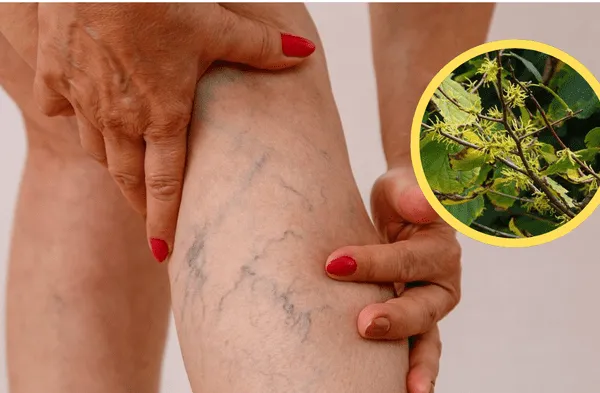 La hierba reduce varices y arañas vasculares, según la UNAM wapa.pe