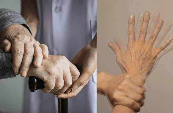 Alimentos que aumentar el riesgo de Parkinson, según Harvard wapa.pe