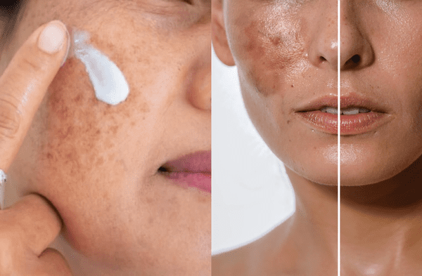 Cremas antimanchas para el rostro wapa.pe