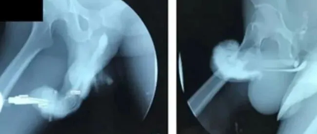 Radiografía de la fractura del pene   