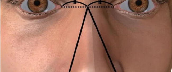 El tamaño de la nariz se definió como la mayor distancia entre el punto medio de los ángulos oculares y el exterior del ala nasal izquierda o derecha.    