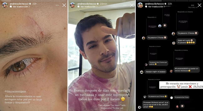 Andrés Vílchez reveló cómo quedó su rostro tras el accidente en el gimnasio.   
